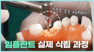 오스템 임플란트 수술과정, 임플란트 종류와 임플란트 심는과정, 가격 금액 비용 치료기간 꿀팁